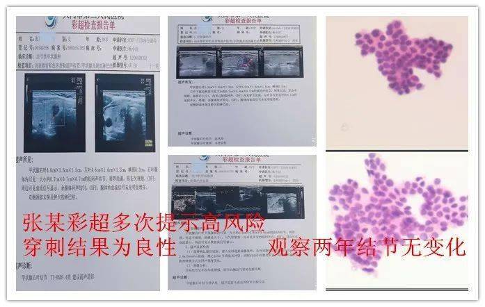 揭開甲狀腺結節真面目細針穿刺抽吸活檢技術