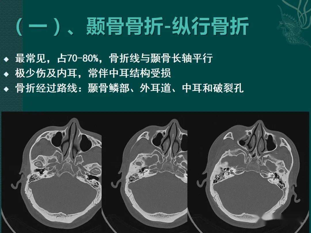 新手看耳部ct片图解图片