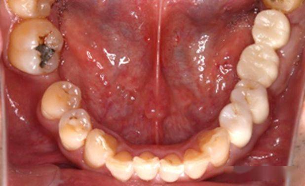 化黏膜的不足,为了达到良好的软硬组织修复效果,促进患者的口腔健康