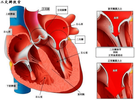 二尖瓣就是心房通往心室的那个阀门,二尖瓣狭窄就会导致心房的血不