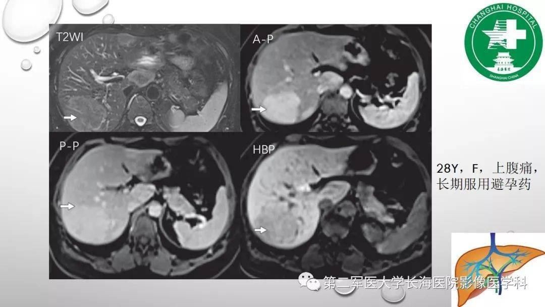 普美显丨肝胆特异性MRI对比剂-钆塞酸二钠Gd-EOB-DTPA-搜狐大视野-搜狐新闻
