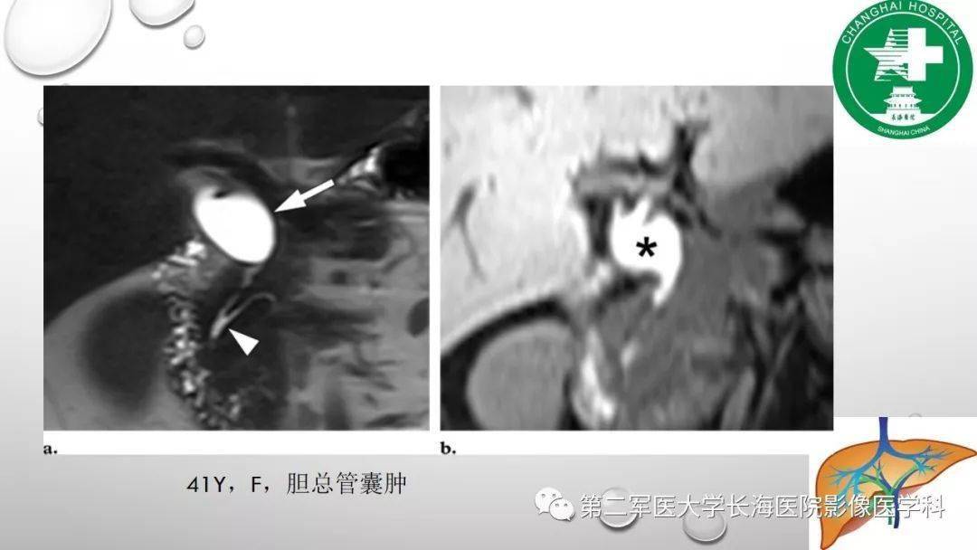 普美显丨肝胆特异性MRI对比剂-钆塞酸二钠Gd-EOB-DTPA-搜狐大视野-搜狐新闻