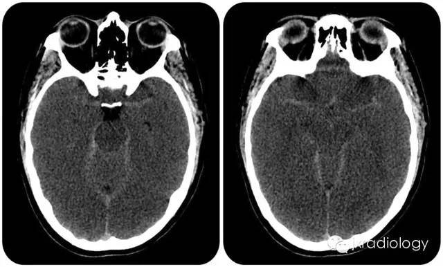 蛛网膜下腔出血MRI图片