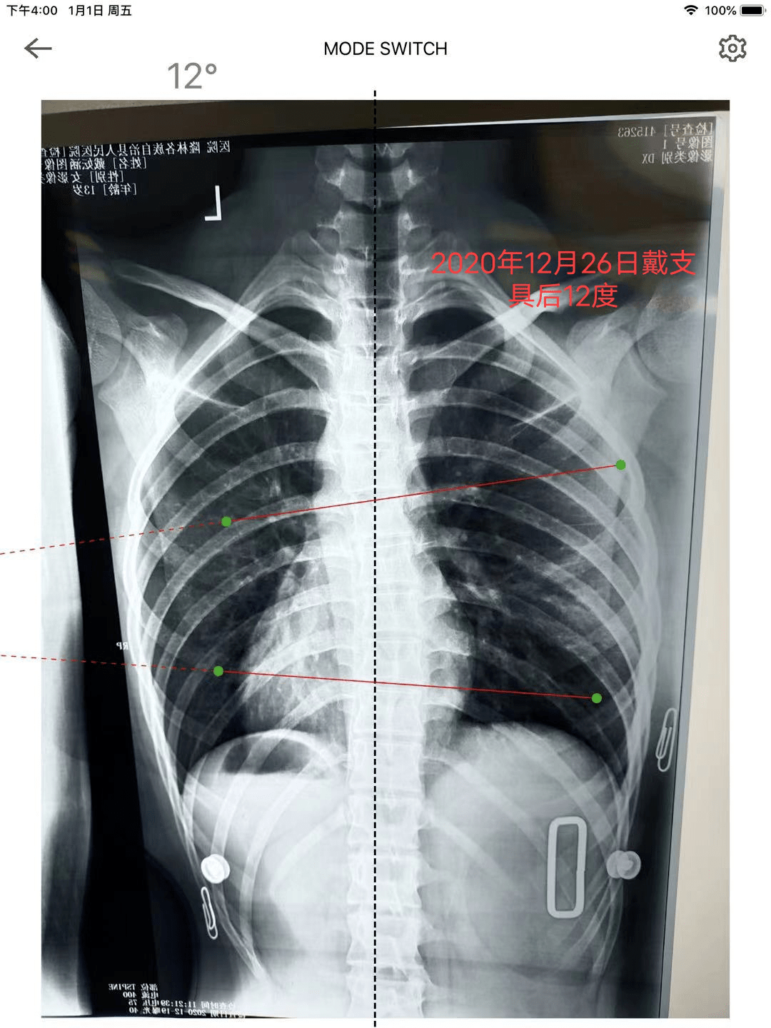 脊椎骨图片医用dr图片