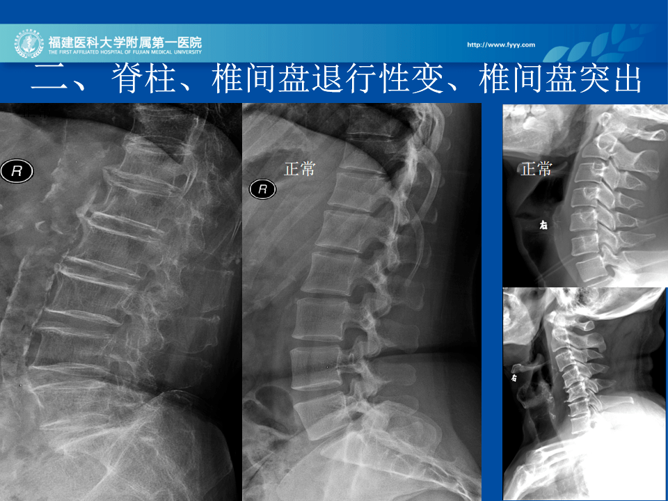 全面詳解脊柱常見病變的影像診斷