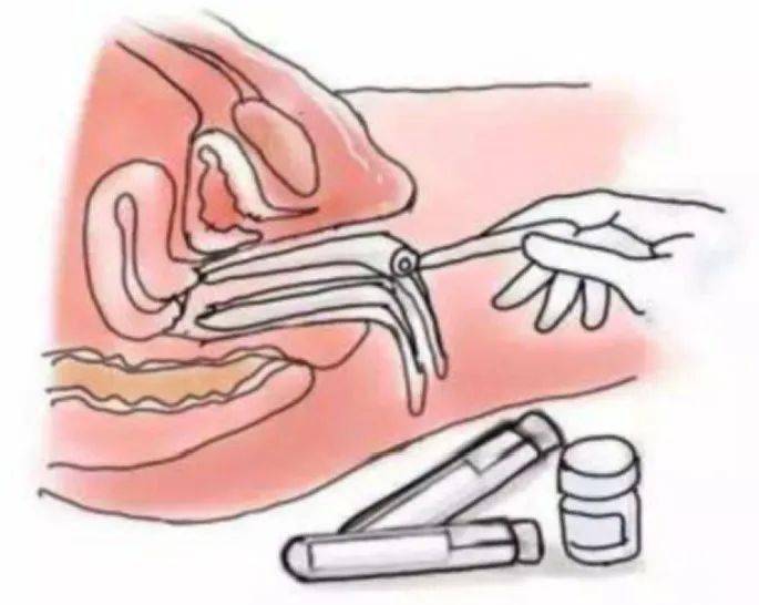 双合诊触摸检查最后,医生还会对患者进行妇科触诊检查,如果已婚,医生