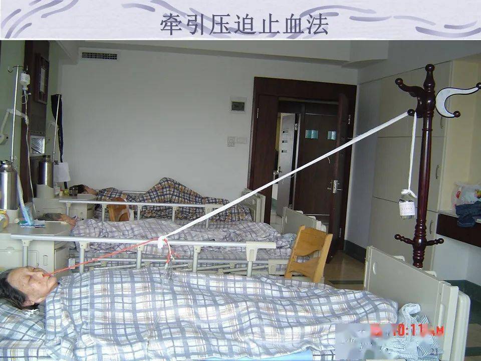 【ppt】三腔二囊管的应用及护理