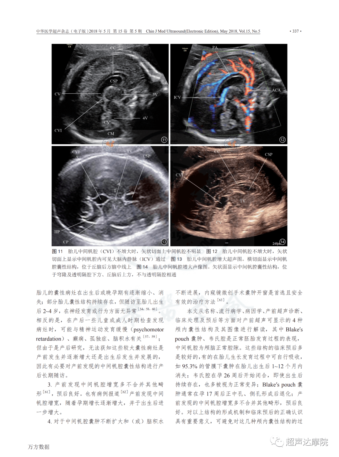 颅内囊性结构室管膜下囊肿布莱克囊肿韦氏腔中间帆腔产前超声报告与