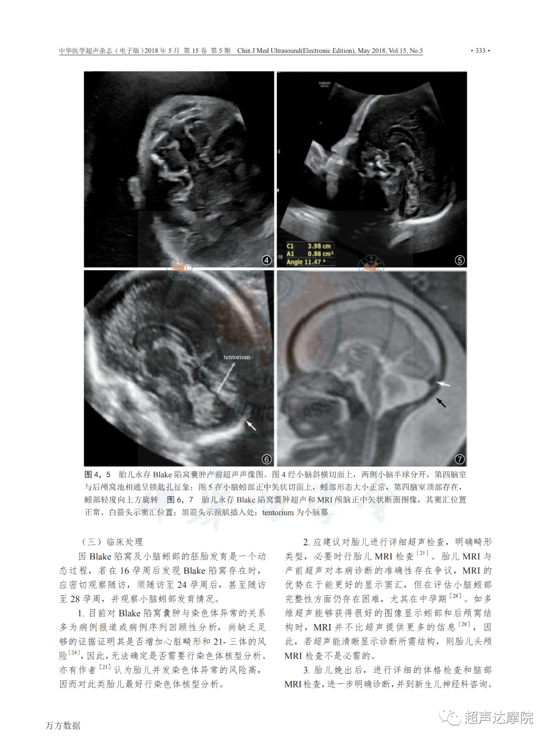 颅内囊性结构室管膜下囊肿布莱克囊肿韦氏腔中间帆腔产前超声报告与