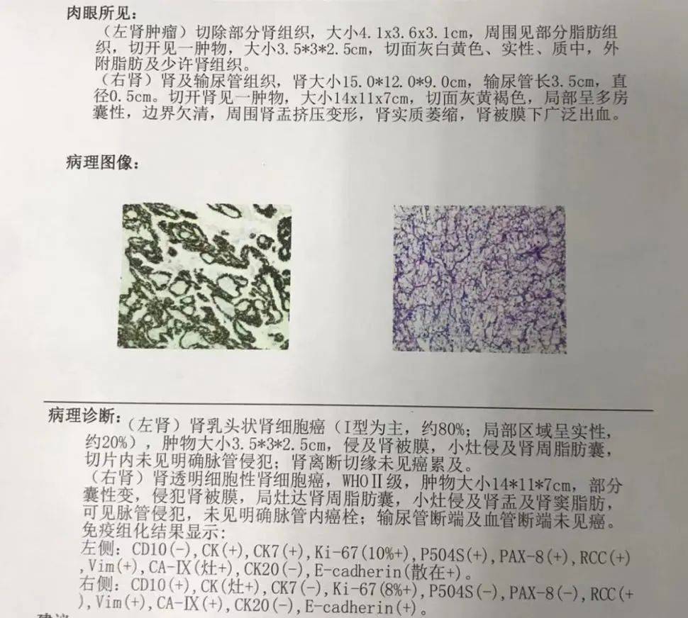 郑州大学五附院泌尿外科成功完成一例双肾巨大肿瘤切除术