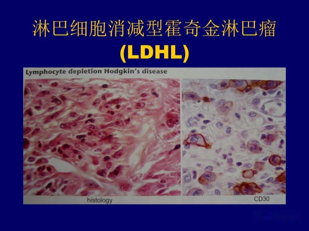 霍奇金淋巴瘤大体图片图片