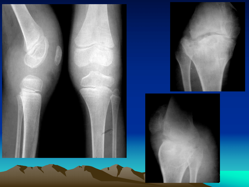 膝关节结核的影像学诊断