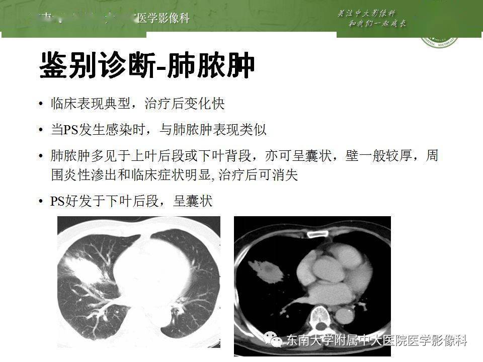 肺隔离症影像表现_郑孝飞