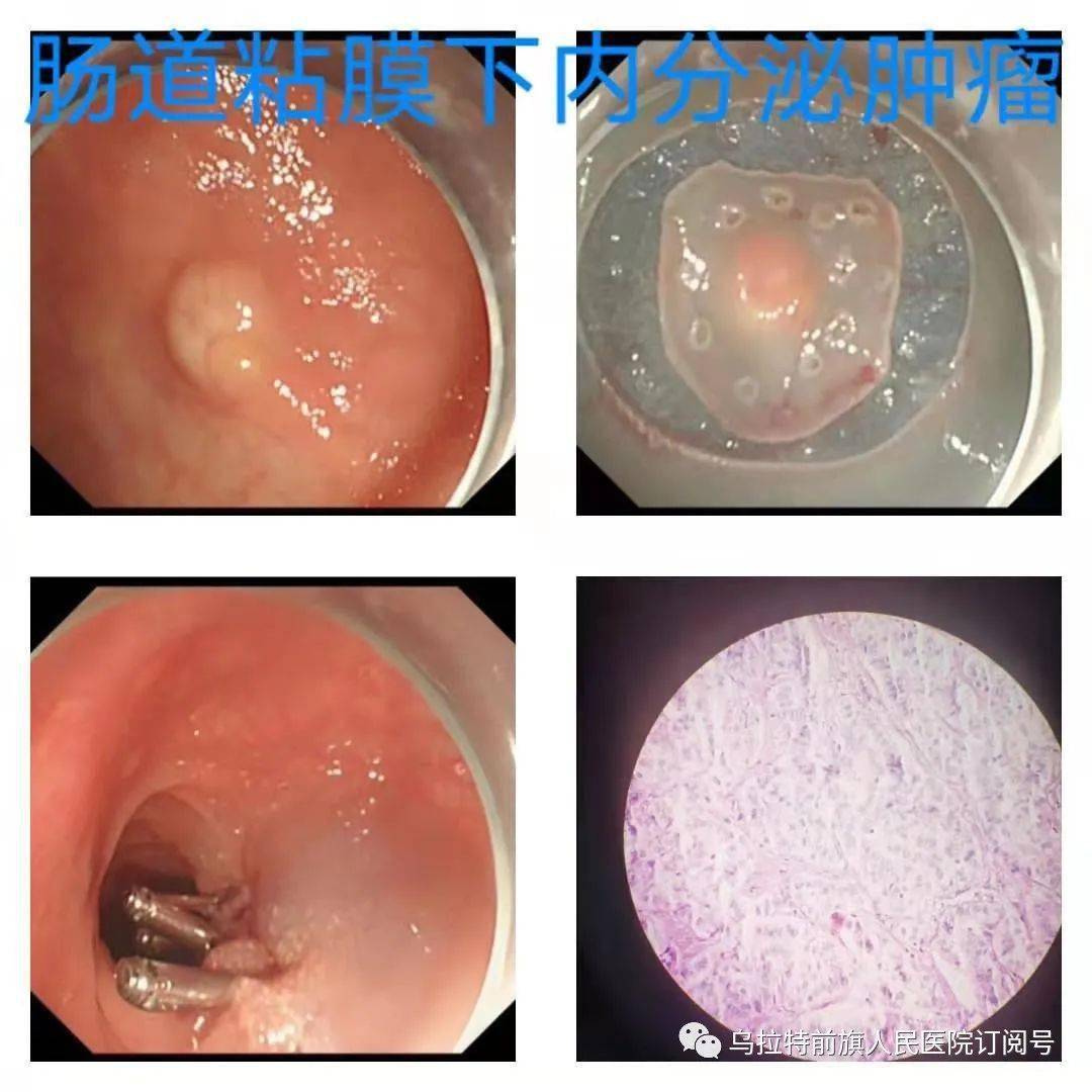 病理证实:1例为肠道早癌,1例为肠道粘膜下类癌(神经内分泌肿瘤),1例回