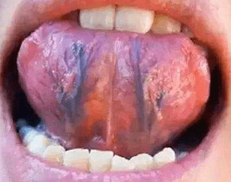 身体健康的时候,舌头下面的静脉血管一般比较正常不突出,但是如果发现