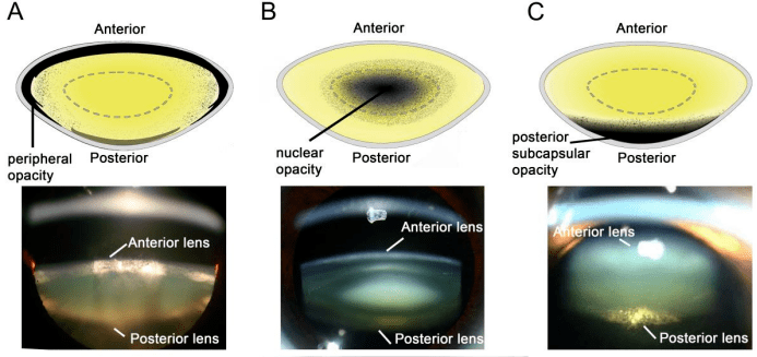 白内障亚型的定位:机制图及裂隙灯图像展示了三种主要的白内障分型