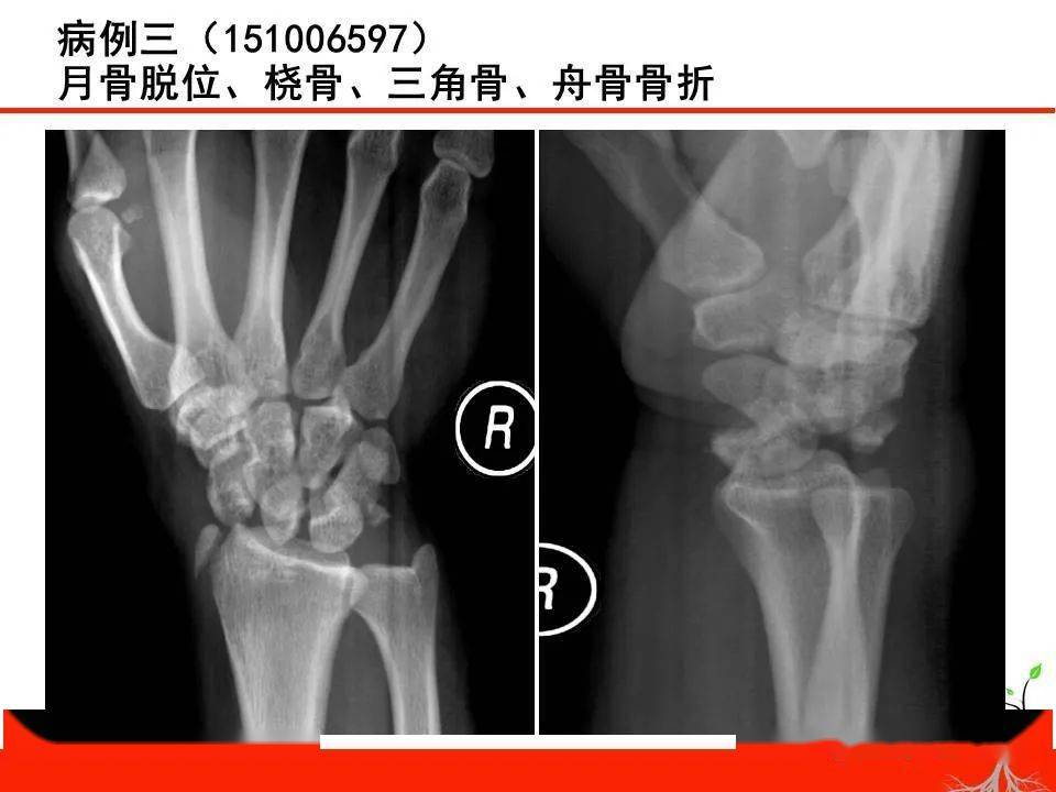 成人腕關節外傷x線診斷