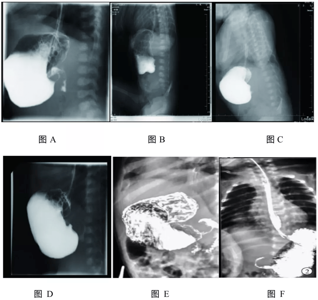 消化道造影肥厚性幽门狭窄的影像特点chps患儿一般在生后2
