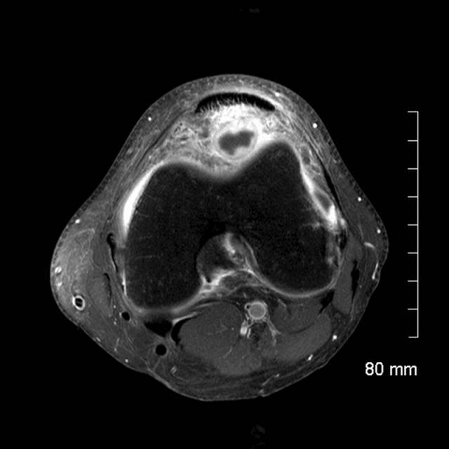 髌骨软化核磁共振图像图片