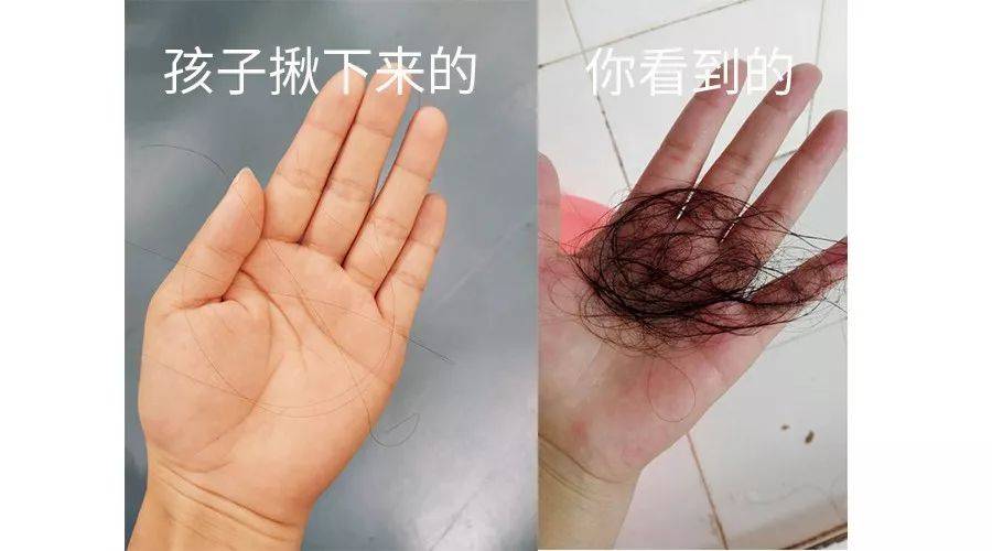 无论是一根还是一撮一把,孩子揪头发,带来的都不仅是生理上的疼痛