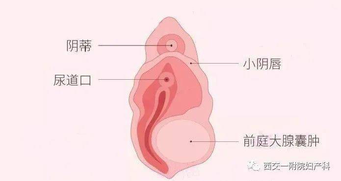 前庭大腺囊肿知多少 治疗