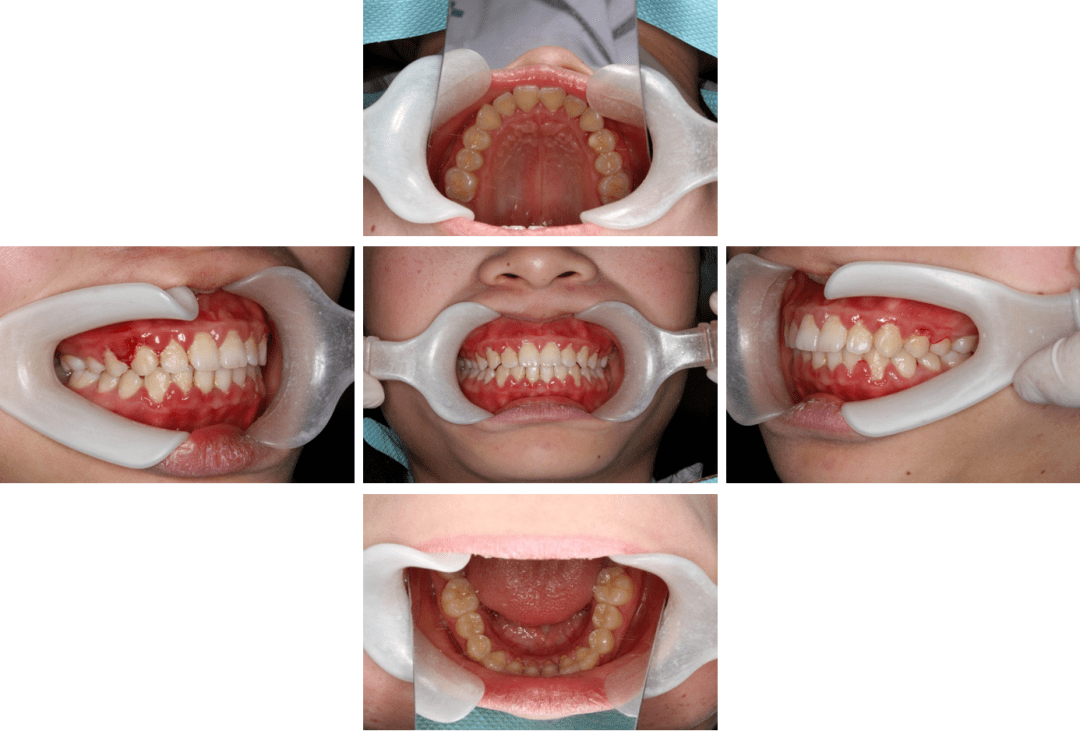 伴口呼吸的牙周炎治疗一例