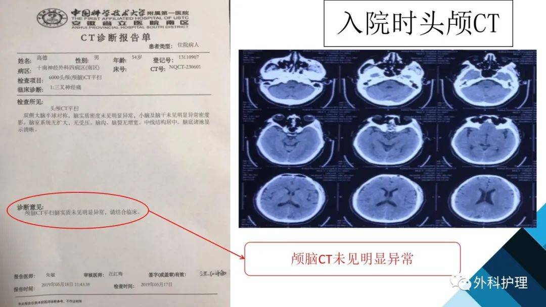 三叉神经痛病历图片