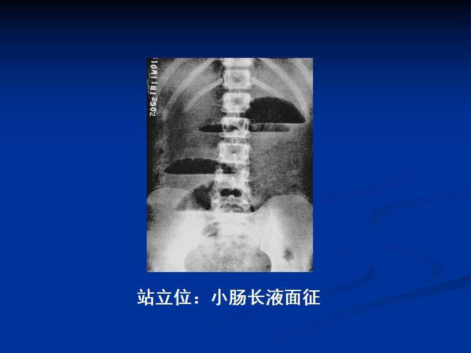 鱼肋征与阶梯状液平面图片