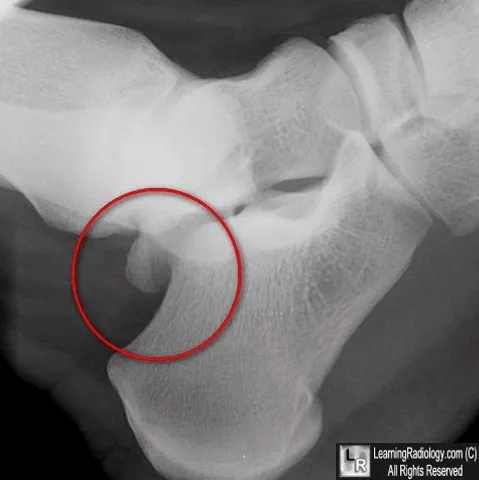 学习易被误诊为骨折的21种结构