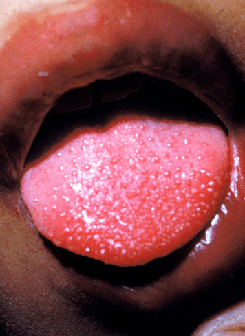 口唇充血发红皲裂,口腔黏膜弥漫充血,舌乳头突起,充血,形似杨梅