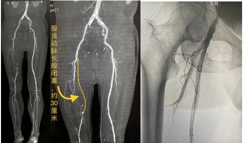 动脉硬化检测的原理是什么_动脉硬化检测