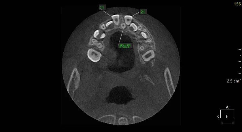 多生牙全景片图片
