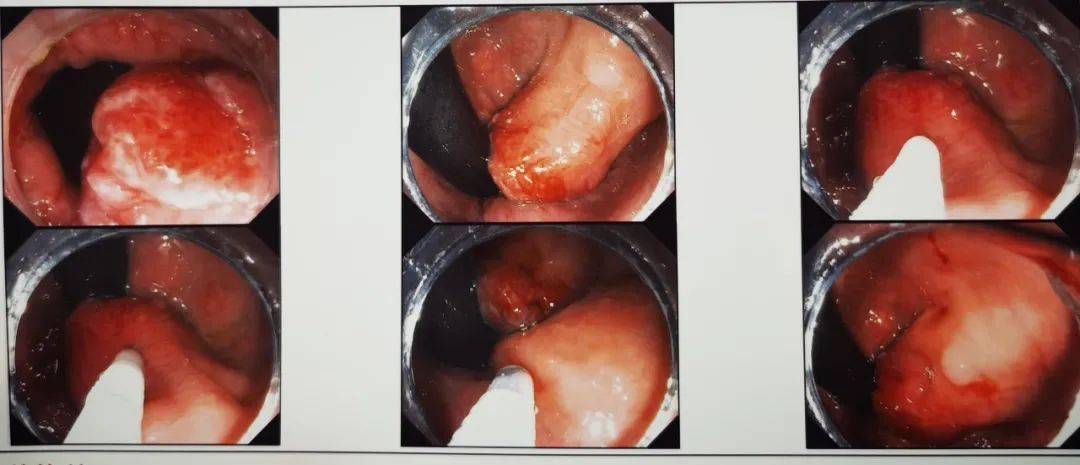 内痔肠镜下图片大全图片