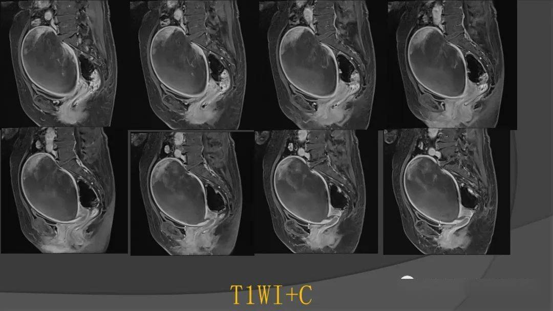 子宫丨子宫内膜癌肉瘤_医学