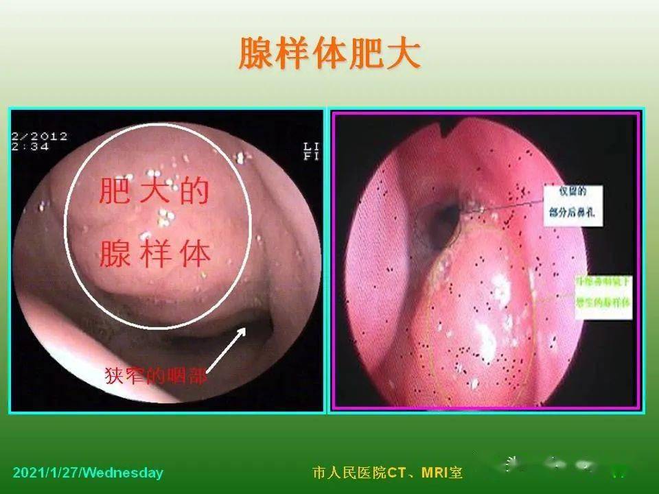 兒童腺樣體肥大影像表現及診斷標準