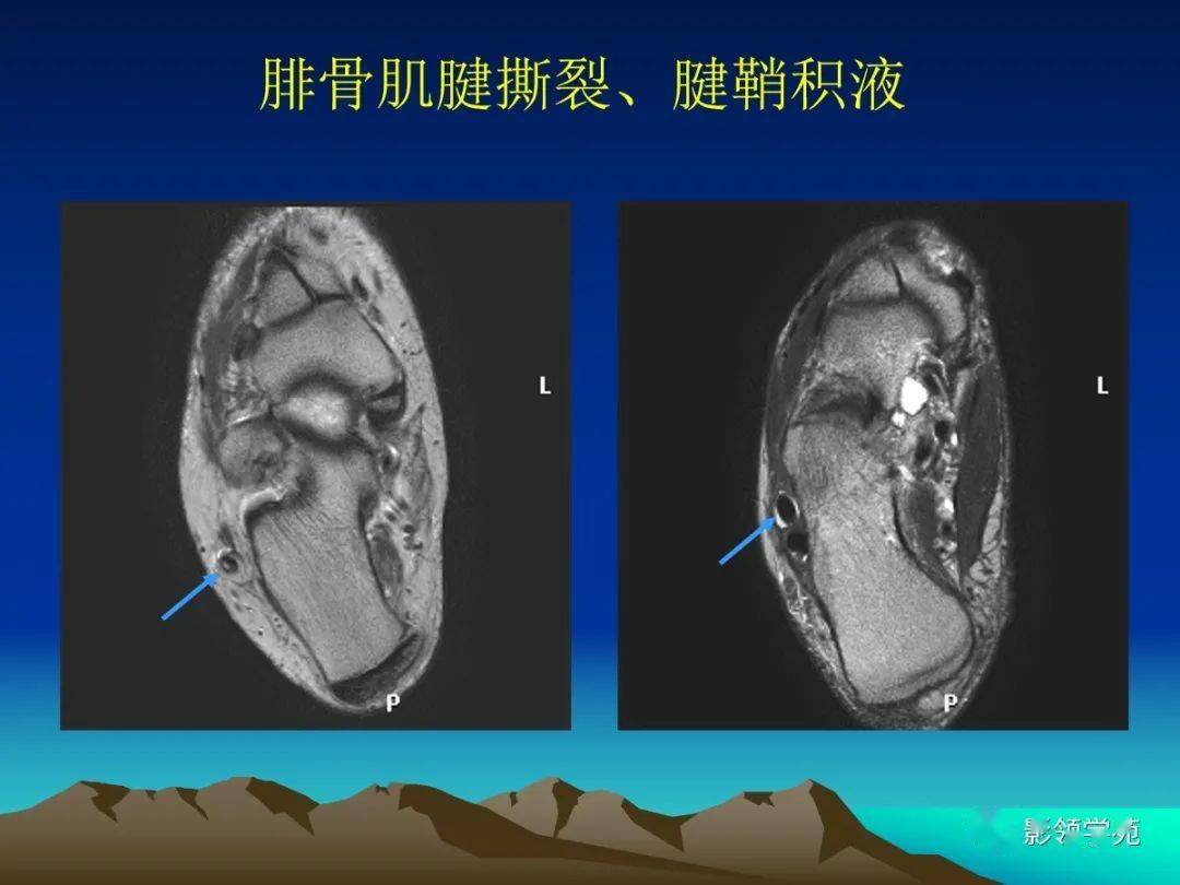 踝關節外側韌帶急性損傷的mri表現