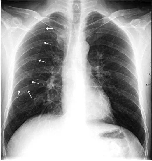 正常肺x光片图片