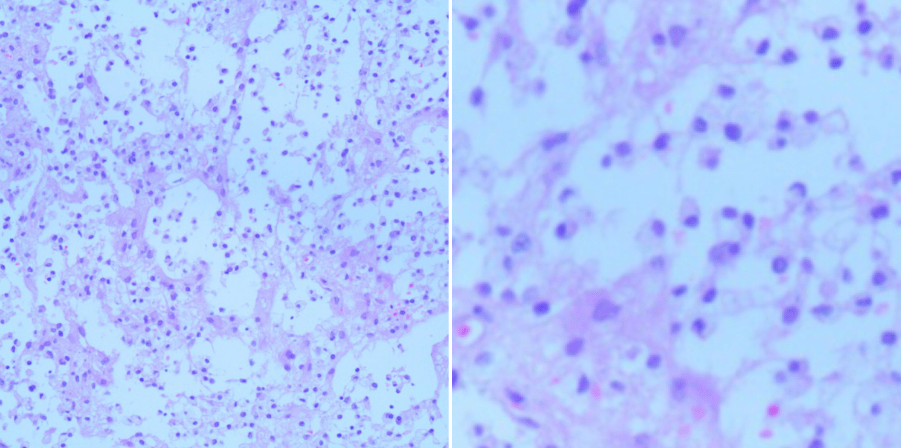 【病例分享】颅内瘤样脱髓鞘病变一例(神经肿瘤系列七)---浙二神外