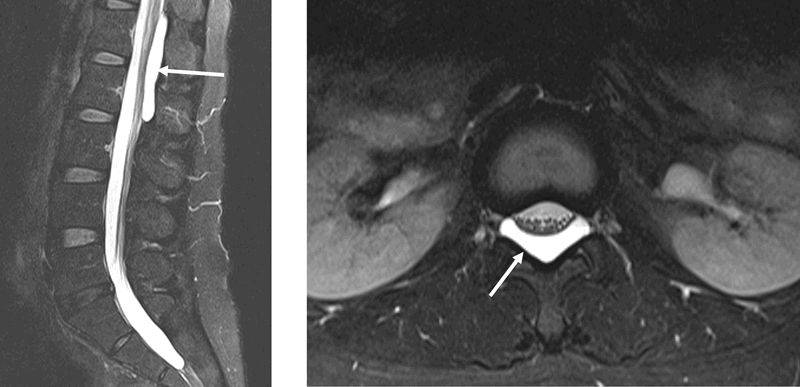 外脊髓蛛網膜囊腫(白色箭頭)位於硬膜囊背側,它向前移位並壓縮硬膜囊