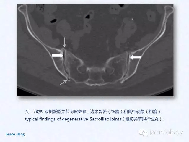 骶髂關節炎x線ct和mri表現