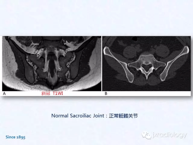 骶髂關節炎x線ct和mri表現