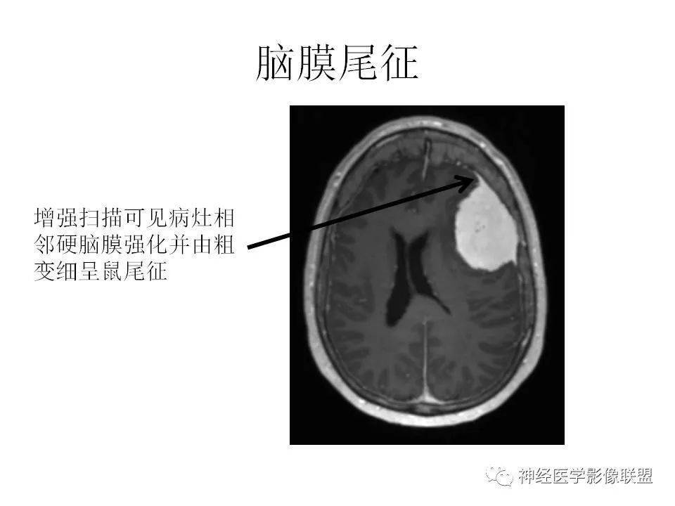 影像总结丨脑膜三件套——脑膜瘤,hpc/sft