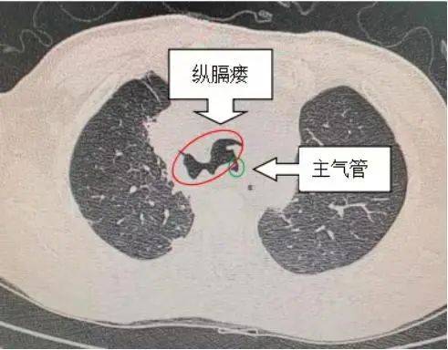 金华市中心医院接诊邹先生后,行胸部ct检查,提示气管与纵膈连接处破损