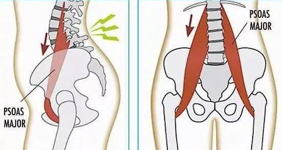 肌僵硬缩短无力,如果是骨盆后倾位的坐姿,髂腰肌就会拉长紧张松弛无力