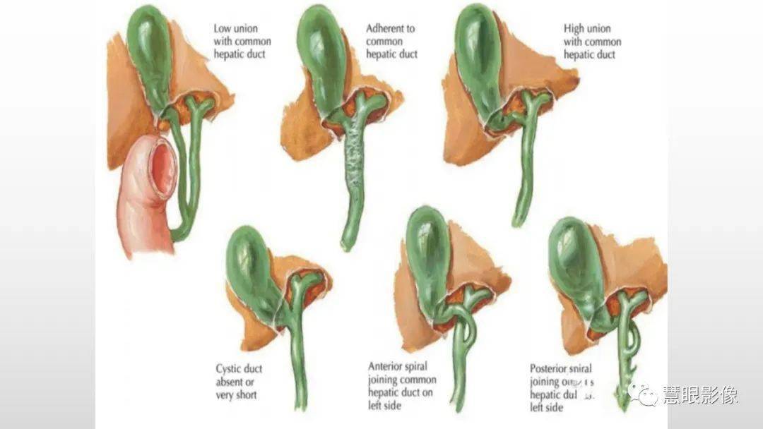 膽道解剖及先天變異