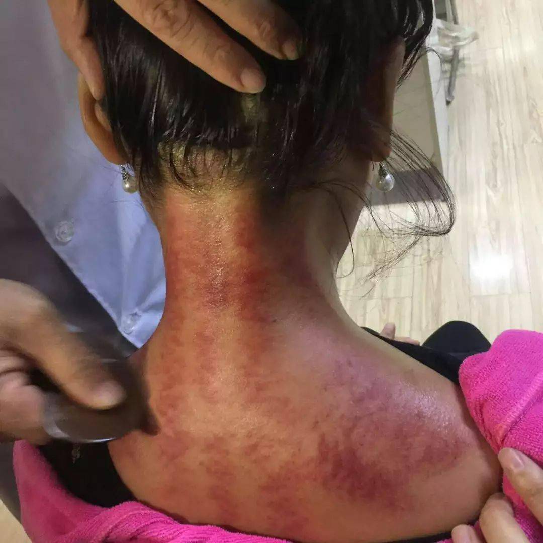 按摩 刮痧 艾灸这个组合,想瘦哪里瘦哪里!_减肥