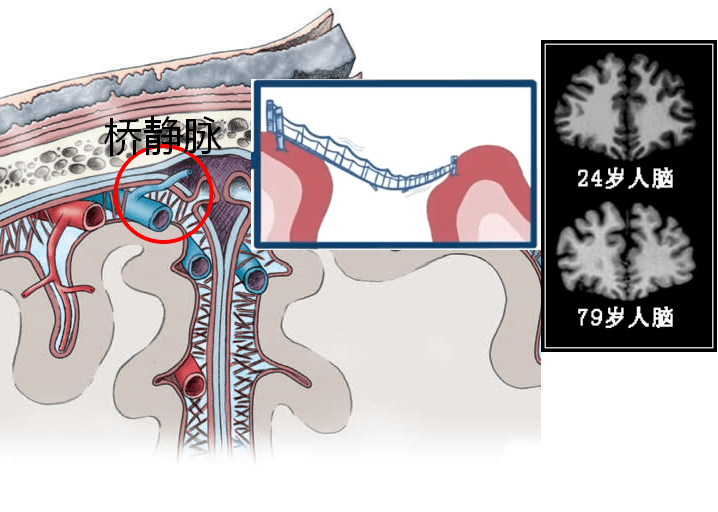 大脑桥静脉示意图图片