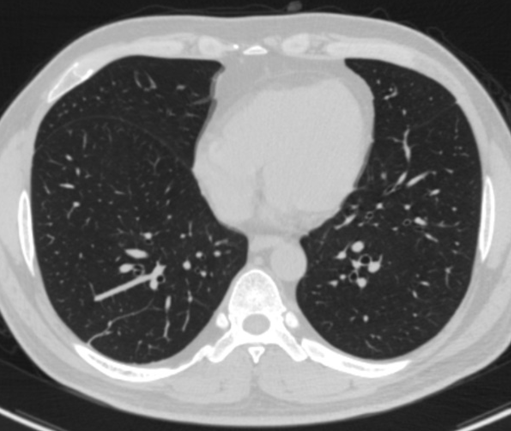 5mm层厚1,扫描层厚影响肺野透过度的因素1mm层厚1