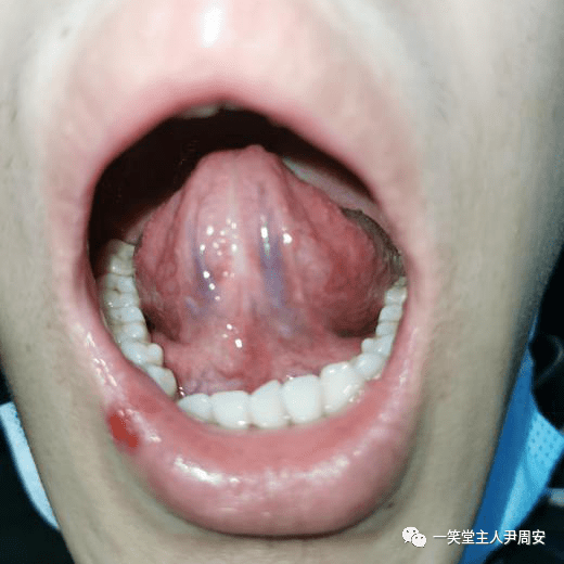 医案 | 新加香薷饮合连朴饮治发热,腹泻案