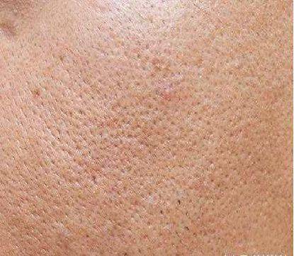 你脸上的角质太厚了有八成的女人不懂得如何正确去角质